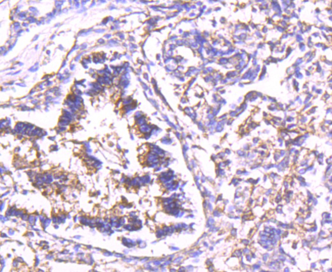 Immunohistochemical analysis of paraffin-embedded human lung tissue using anti-Calpain 2 antibody. The section was pre-treated using heat mediated antigen retrieval with Tris-EDTA buffer (pH 8.0-8.4) for 20 minutes.The tissues were blocked in 5% BSA for 30 minutes at room temperature, washed with ddH2O and PBS, and then probed with the primary antibody (ET1704-90, 1/50) for 30 minutes at room temperature. The detection was performed using an HRP conjugated compact polymer system. DAB was used as the chromogen. Tissues were counterstained with hematoxylin and mounted with DPX.