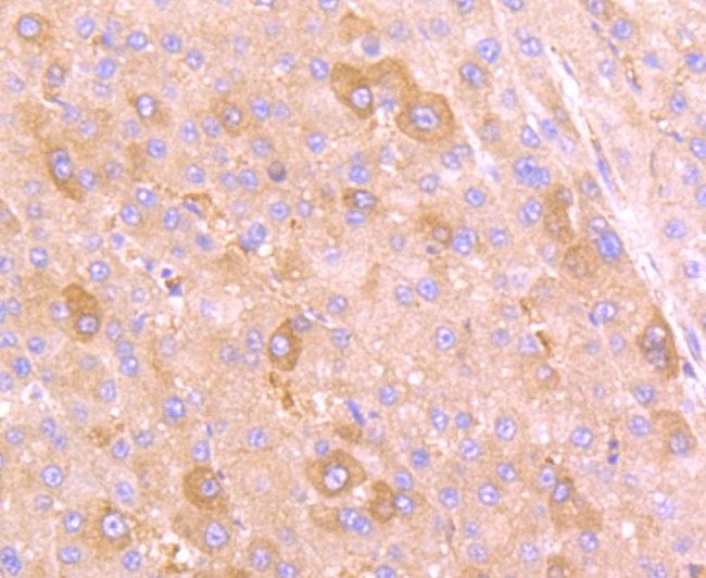 Immunohistochemical analysis of paraffin-embedded human liver carcinoma tissue using anti-PLGF antibody. The section was pre-treated using heat mediated antigen retrieval with Tris-EDTA buffer (pH 8.0-8.4) for 20 minutes.The tissues were blocked in 5% BSA for 30 minutes at room temperature, washed with ddH2O and PBS, and then probed with the primary antibody (ET1704-99, 1/50) for 30 minutes at room temperature. The detection was performed using an HRP conjugated compact polymer system. DAB was used as the chromogen. Tissues were counterstained with hematoxylin and mounted with DPX.