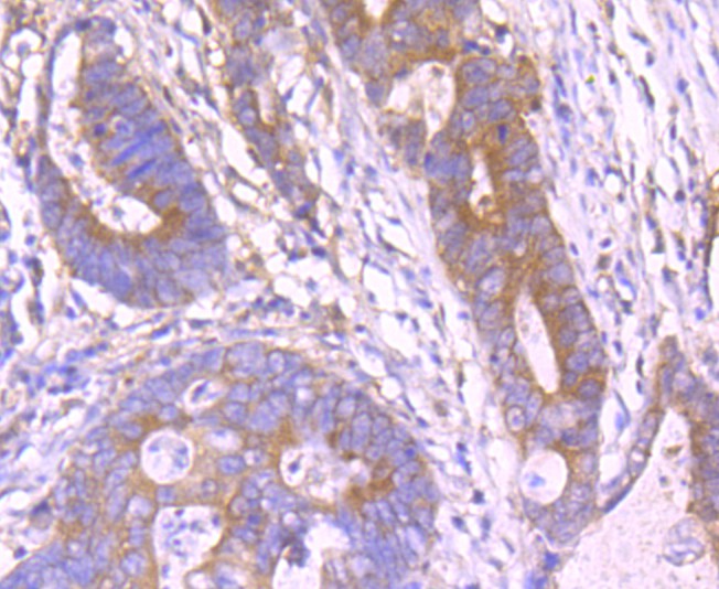 Immunohistochemical analysis of paraffin-embedded human colon carcinoma tissue using anti-PLGF antibody. The section was pre-treated using heat mediated antigen retrieval with Tris-EDTA buffer (pH 8.0-8.4) for 20 minutes.The tissues were blocked in 5% BSA for 30 minutes at room temperature, washed with ddH2O and PBS, and then probed with the primary antibody (ET1704-99, 1/50) for 30 minutes at room temperature. The detection was performed using an HRP conjugated compact polymer system. DAB was used as the chromogen. Tissues were counterstained with hematoxylin and mounted with DPX.