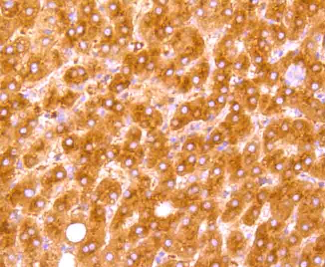 Immunohistochemical analysis of paraffin-embedded human liver carcinoma tissue using anti-C4 antibody. The section was pre-treated using heat mediated antigen retrieval with Tris-EDTA buffer (pH 9.0) for 20 minutes.The tissues were blocked in 1% BSA for 30 minutes at room temperature, washed with ddH2O and PBS, and then probed with the primary antibody (ET1705-10, 1/50) for 30 minutes at room temperature. The detection was performed using an HRP conjugated compact polymer system. DAB was used as the chromogen. Tissues were counterstained with hematoxylin and mounted with DPX.