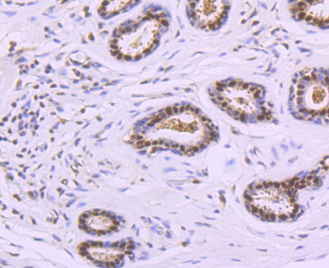 Immunohistochemical analysis of paraffin-embedded human breast carcinoma tissue using anti-DNA Polymerase beta antibody. The section was pre-treated using heat mediated antigen retrieval with sodium citrate buffer (pH 6.0) for 20 minutes. The tissues were blocked in 5% BSA for 30 minutes at room temperature, washed with ddH2O and PBS, and then probed with the primary antibody (ET1705-12, 1/50)  for 30 minutes at room temperature. The detection was performed using an HRP conjugated compact polymer system. DAB was used as the chromogen. Tissues were counterstained with hematoxylin and mounted with DPX.