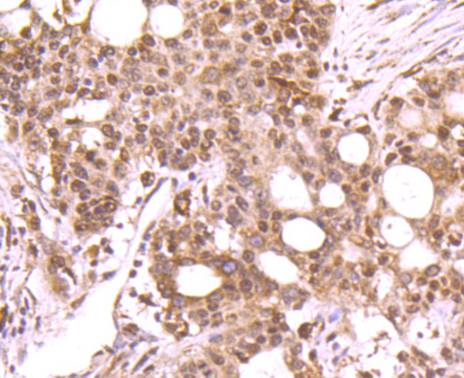 Immunohistochemical analysis of paraffin-embedded human stomach carcinoma tissue using anti-DNA Polymerase beta antibody. The section was pre-treated using heat mediated antigen retrieval with sodium citrate buffer (pH 6.0) for 20 minutes. The tissues were blocked in 5% BSA for 30 minutes at room temperature, washed with ddH2O and PBS, and then probed with the primary antibody (ET1705-12, 1/50)  for 30 minutes at room temperature. The detection was performed using an HRP conjugated compact polymer system. DAB was used as the chromogen. Tissues were counterstained with hematoxylin and mounted with DPX.