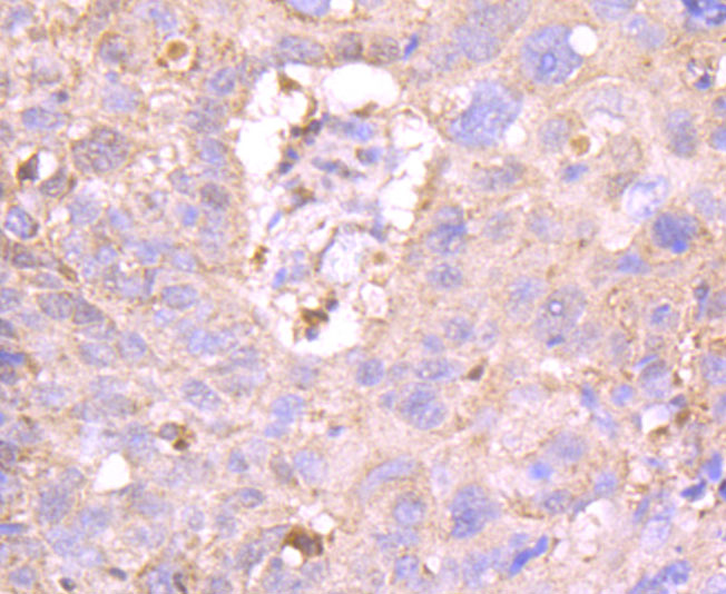Immunohistochemical analysis of paraffin-embedded human lung carcinoma tissue using anti-MUC4 antibody. The section was pre-treated using heat mediated antigen retrieval with Tris-EDTA buffer (pH 9.0) for 20 minutes.The tissues were blocked in 1% BSA for 30 minutes at room temperature, washed with ddH2O and PBS, and then probed with the primary antibody (ET1705-13, 1/50) for 30 minutes at room temperature. The detection was performed using an HRP conjugated compact polymer system. DAB was used as the chromogen. Tissues were counterstained with hematoxylin and mounted with DPX.