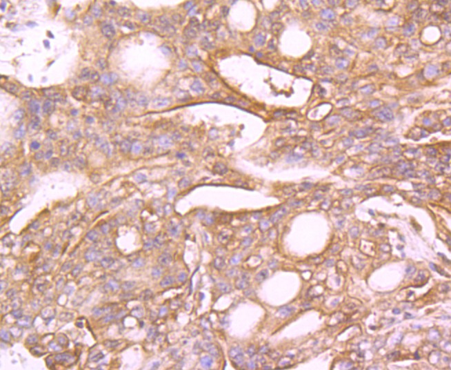 Immunohistochemical analysis of paraffin-embedded human stomach carcinoma tissue using anti-MUC4 antibody. The section was pre-treated using heat mediated antigen retrieval with Tris-EDTA buffer (pH 9.0) for 20 minutes.The tissues were blocked in 1% BSA for 30 minutes at room temperature, washed with ddH2O and PBS, and then probed with the primary antibody (ET1705-13, 1/50) for 30 minutes at room temperature. The detection was performed using an HRP conjugated compact polymer system. DAB was used as the chromogen. Tissues were counterstained with hematoxylin and mounted with DPX.
