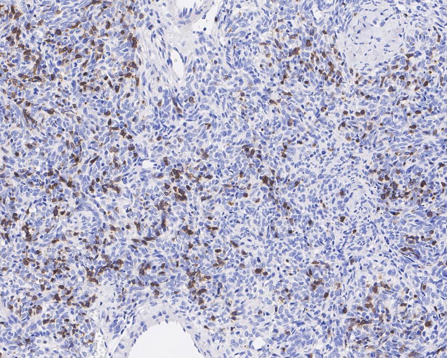 Immunohistochemical analysis of paraffin-embedded human tonsil tissue using anti-CD1a antibody. The section was pre-treated using heat mediated antigen retrieval with Tris-EDTA buffer (pH 8.0-8.4) for 20 minutes.The tissues were blocked in 5% BSA for 30 minutes at room temperature, washed with ddH2O and PBS, and then probed with the primary antibody (ET1705-17, 1/50) for 30 minutes at room temperature. The detection was performed using an HRP conjugated compact polymer system. DAB was used as the chromogen. Tissues were counterstained with hematoxylin and mounted with DPX.