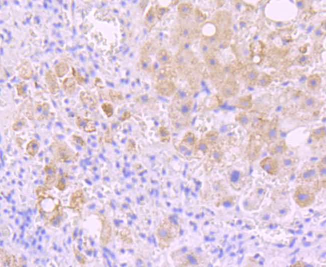 Immunohistochemical analysis of paraffin-embedded human liver carcinoma tissue using anti-Insulin Receptor R antibody. The section was pre-treated using heat mediated antigen retrieval with Tris-EDTA buffer (pH 9.0) for 20 minutes.The tissues were blocked in 1% BSA for 30 minutes at room temperature, washed with ddH2O and PBS, and then probed with the primary antibody (ET1705-22, 1/50) for 30 minutes at room temperature. The detection was performed using an HRP conjugated compact polymer system. DAB was used as the chromogen. Tissues were counterstained with hematoxylin and mounted with DPX.