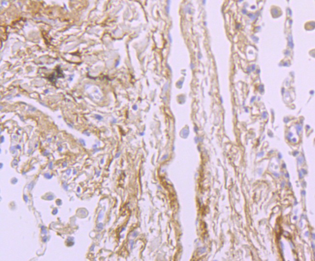 Immunohistochemical analysis of paraffin-embedded human lung carcinoma tissue using anti-TGFBI antibody. The section was pre-treated using heat mediated antigen retrieval with Tris-EDTA buffer (pH 8.0-8.4) for 20 minutes.The tissues were blocked in 5% BSA for 30 minutes at room temperature, washed with ddH2O and PBS, and then probed with the primary antibody (ET1705-29, 1/50) for 30 minutes at room temperature. The detection was performed using an HRP conjugated compact polymer system. DAB was used as the chromogen. Tissues were counterstained with hematoxylin and mounted with DPX.