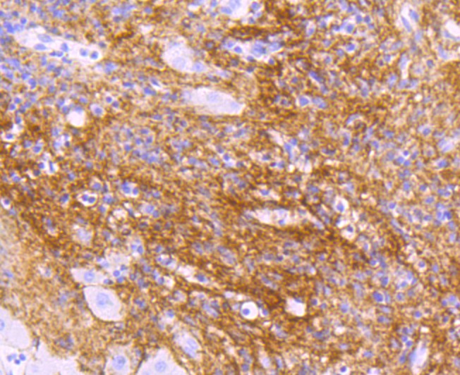 Immunohistochemical analysis of paraffin-embedded human liver carcinoma tissue using anti-TGFBI antibody. The section was pre-treated using heat mediated antigen retrieval with Tris-EDTA buffer (pH 8.0-8.4) for 20 minutes.The tissues were blocked in 5% BSA for 30 minutes at room temperature, washed with ddH2O and PBS, and then probed with the primary antibody (ET1705-29, 1/50) for 30 minutes at room temperature. The detection was performed using an HRP conjugated compact polymer system. DAB was used as the chromogen. Tissues were counterstained with hematoxylin and mounted with DPX.