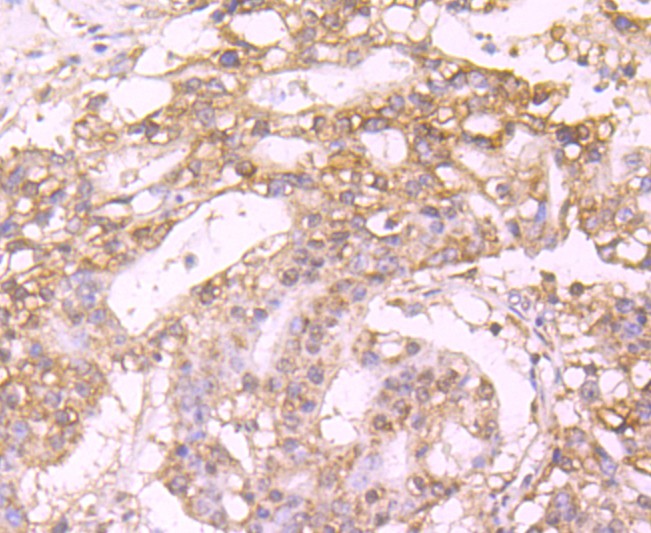 Immunohistochemical analysis of paraffin-embedded human stomach carcinoma tissue using anti-Protein C antibody. The section was pre-treated using heat mediated antigen retrieval with Tris-EDTA buffer (pH 9.0) for 20 minutes.The tissues were blocked in 1% BSA for 30 minutes at room temperature, washed with ddH2O and PBS, and then probed with the primary antibody (ET1705-3, 1/50) for 30 minutes at room temperature. The detection was performed using an HRP conjugated compact polymer system. DAB was used as the chromogen. Tissues were counterstained with hematoxylin and mounted with DPX.