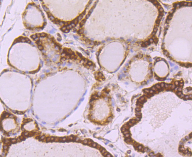 Immunohistochemical analysis of paraffin-embedded human thyroid tissue using anti-alpha Tubulin 4A antibody. The section was pre-treated using heat mediated antigen retrieval with Tris-EDTA buffer (pH 8.0-8.4) for 20 minutes.The tissues were blocked in 5% BSA for 30 minutes at room temperature, washed with ddH2O and PBS, and then probed with the primary antibody (ET1705-31, 1/50) for 30 minutes at room temperature. The detection was performed using an HRP conjugated compact polymer system. DAB was used as the chromogen. Tissues were counterstained with hematoxylin and mounted with DPX.