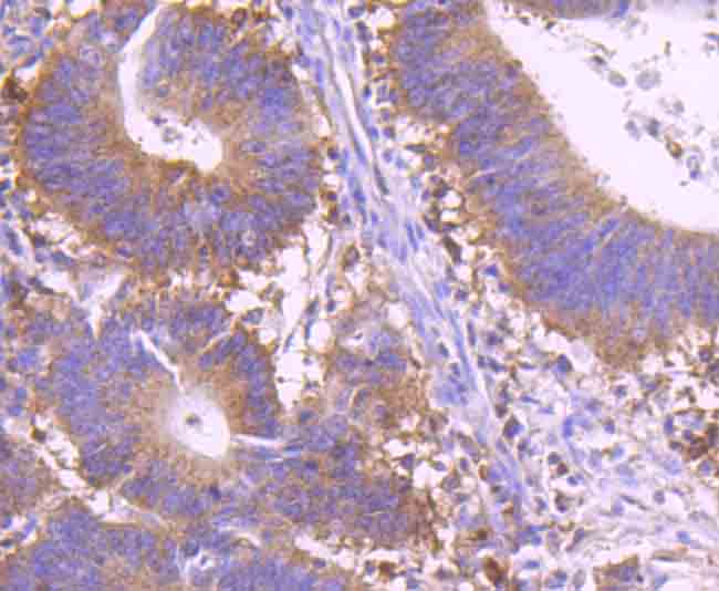 Immunohistochemical analysis of paraffin-embedded human colon cancer tissue using anti-c-Rel antibody. Counter stained with hematoxylin.