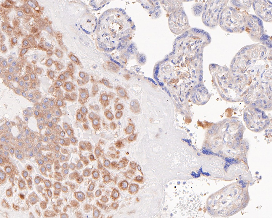 Immunohistochemical analysis of paraffin-embedded human placenta tissue with Rabbit anti-NFkB p100 antibody (ET1705-45) at 1/200 dilution.<br />
<br />
The section was pre-treated using heat mediated antigen retrieval with sodium citrate buffer (pH 6.0) for 2 minutes. The tissues were blocked in 1% BSA for 20 minutes at room temperature, washed with ddH2O and PBS, and then probed with the primary antibody (ET1705-45) at 1/200 dilution for 1 hour at room temperature. The detection was performed using an HRP conjugated compact polymer system. DAB was used as the chromogen. Tissues were counterstained with hematoxylin and mounted with DPX.