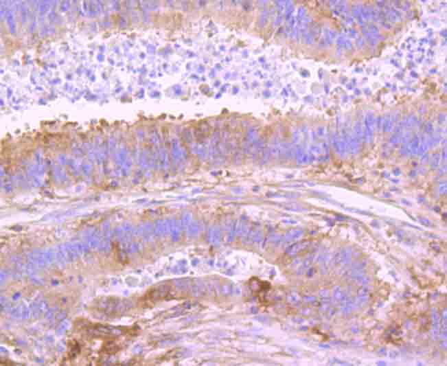 Immunohistochemical analysis of paraffin-embedded human colon carcinoma tissue using anti-NFkB p100 antibody. The section was pre-treated using heat mediated antigen retrieval with Tris-EDTA buffer (pH 8.0-8.4) for 20 minutes.The tissues were blocked in 5% BSA for 30 minutes at room temperature, washed with ddH2O and PBS, and then probed with the primary antibody (ET1705-45, 1/50) for 30 minutes at room temperature. The detection was performed using an HRP conjugated compact polymer system. DAB was used as the chromogen. Tissues were counterstained with hematoxylin and mounted with DPX.
