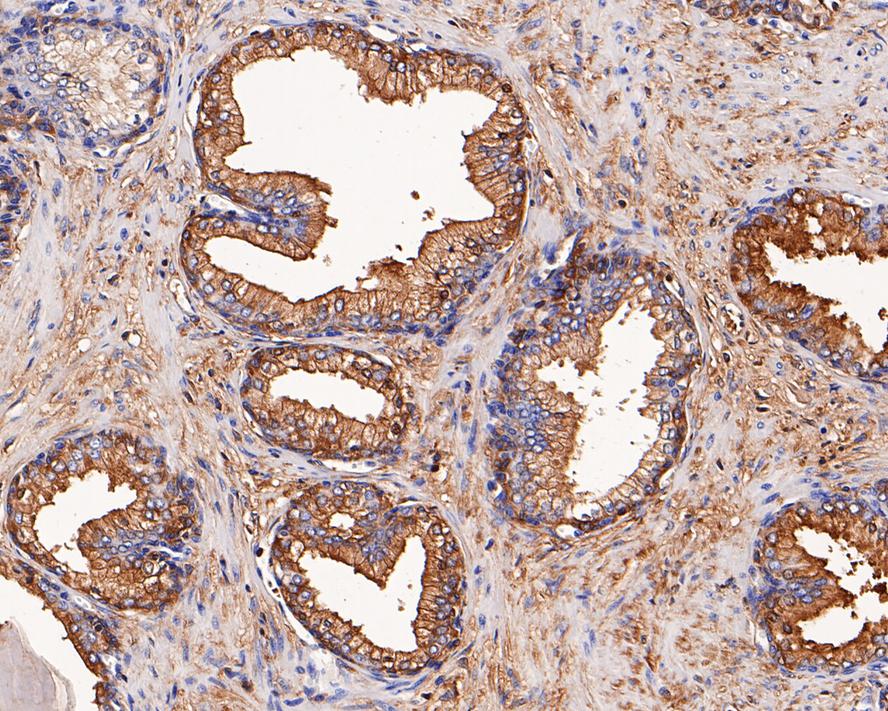 Immunohistochemical analysis of paraffin-embedded human prostate tissue using anti-alpha 1 Antichymotrypsin antibody. Counter stained with hematoxylin.