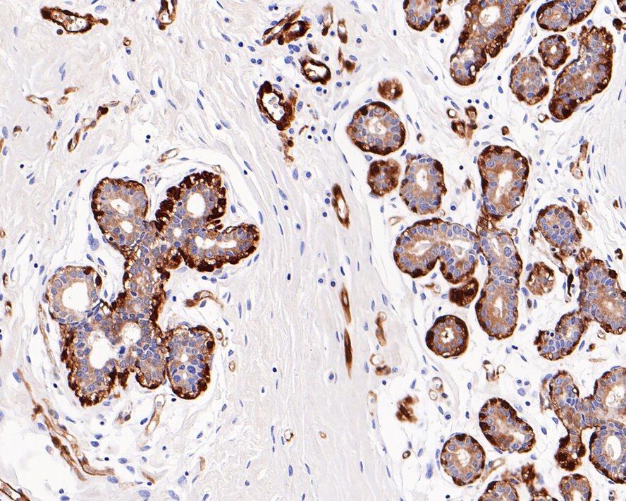 Immunohistochemical analysis of paraffin-embedded human breast carcinoma tissue using anti-gamma Synuclein antibody. The section was pre-treated using heat mediated antigen retrieval with Tris-EDTA buffer (pH 9.0) for 20 minutes.The tissues were blocked in 1% BSA for 30 minutes at room temperature, washed with ddH2O and PBS, and then probed with the primary antibody (ET1705-48, 1/50) for 30 minutes at room temperature. The detection was performed using an HRP conjugated compact polymer system. DAB was used as the chromogen. Tissues were counterstained with hematoxylin and mounted with DPX.