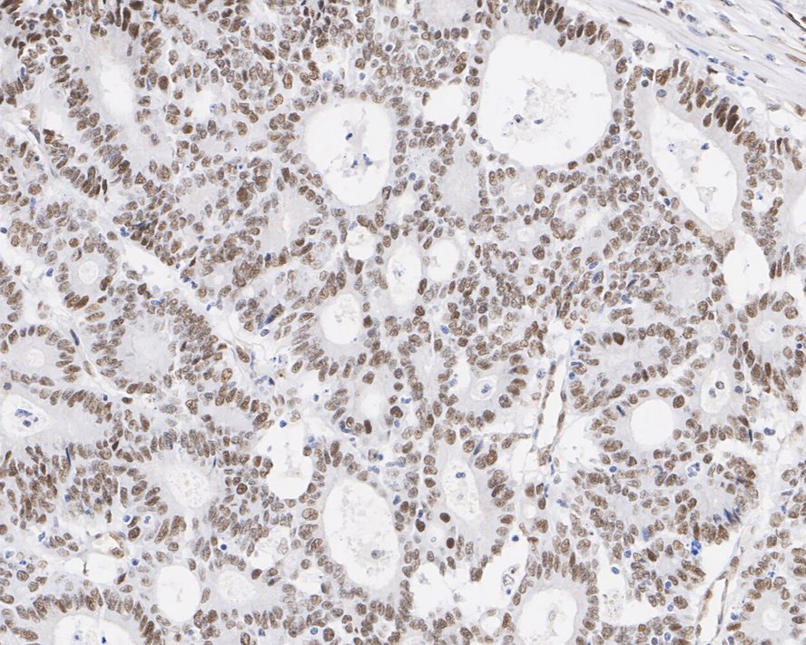 Immunohistochemical analysis of paraffin-embedded human tonsil tissue using anti-ATM (phospho S1981) antibody. The section was pre-treated using heat mediated antigen retrieval with Tris-EDTA buffer (pH 8.0-8.4) for 20 minutes.The tissues were blocked in 5% BSA for 30 minutes at room temperature, washed with ddH2O and PBS, and then probed with the primary antibody (ET1705-50, 1/50) for 30 minutes at room temperature. The detection was performed using an HRP conjugated compact polymer system. DAB was used as the chromogen. Tissues were counterstained with hematoxylin and mounted with DPX.