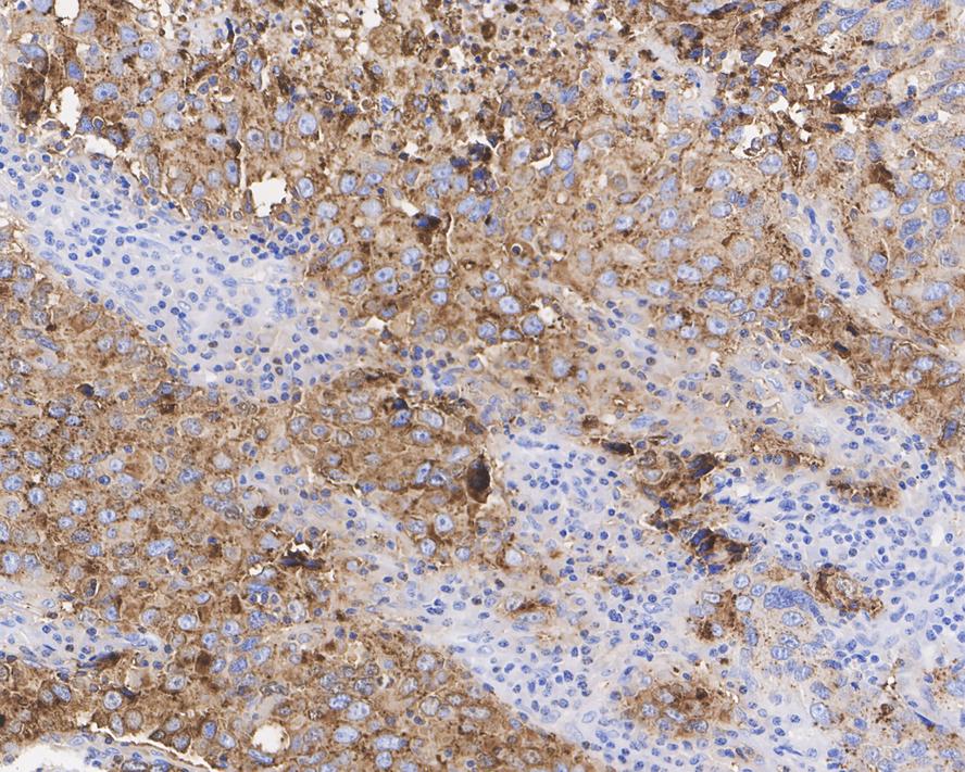 Immunohistochemical analysis of paraffin-embedded human stomach carcinoma tissue using anti-Carcino Embryonic Antigen CEA antibody. The section was pre-treated using heat mediated antigen retrieval with Tris-EDTA buffer (pH 9.0) for 20 minutes.The tissues were blocked in 1% BSA for 30 minutes at room temperature, washed with ddH2O and PBS, and then probed with the primary antibody (ET1705-52, 1/50) for 30 minutes at room temperature. The detection was performed using an HRP conjugated compact polymer system. DAB was used as the chromogen. Tissues were counterstained with hematoxylin and mounted with DPX.