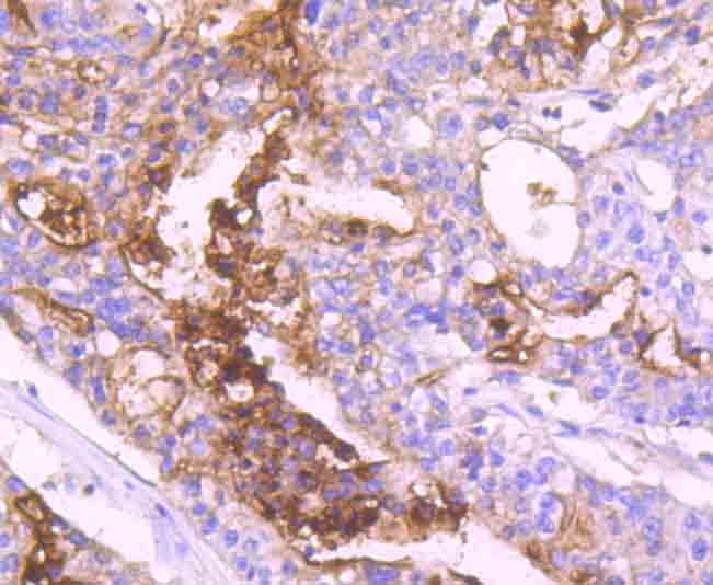 Immunohistochemical analysis of paraffin-embedded human colon carcinoma tissue using anti-Carcino Embryonic Antigen CEA antibody. The section was pre-treated using heat mediated antigen retrieval with Tris-EDTA buffer (pH 9.0) for 20 minutes.The tissues were blocked in 1% BSA for 30 minutes at room temperature, washed with ddH2O and PBS, and then probed with the primary antibody (ET1705-52, 1/50) for 30 minutes at room temperature. The detection was performed using an HRP conjugated compact polymer system. DAB was used as the chromogen. Tissues were counterstained with hematoxylin and mounted with DPX.