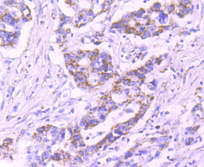 Immunohistochemical analysis of paraffin-embedded human stomach cancer tissue using anti-Pyruvate Dehydrogenase E1 beta subunit antibody. Counter stained with hematoxylin.