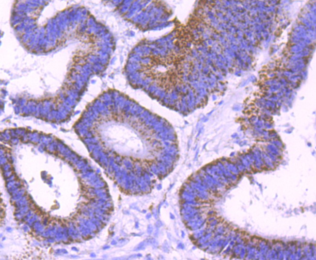 Immunohistochemical analysis of paraffin-embedded human colon cancer tissue with Rabbit anti-SMYD3 antibody (ET1705-58) at 1/50 dilution.Hela cells<br />
The section was pre-treated using heat mediated antigen retrieval with Tris-EDTA buffer (pH 9.0) for 20 minutes. The tissues were blocked in 1% BSA for 20 minutes at room temperature, washed with ddH2O and PBS, and then probed with the primary antibody (ET1705-58) at 1/50 dilution for 1 hour at room temperature. The detection was performed using an HRP conjugated compact polymer system. DAB was used as the chromogen. Tissues were counterstained with hematoxylin and mounted with DPX.