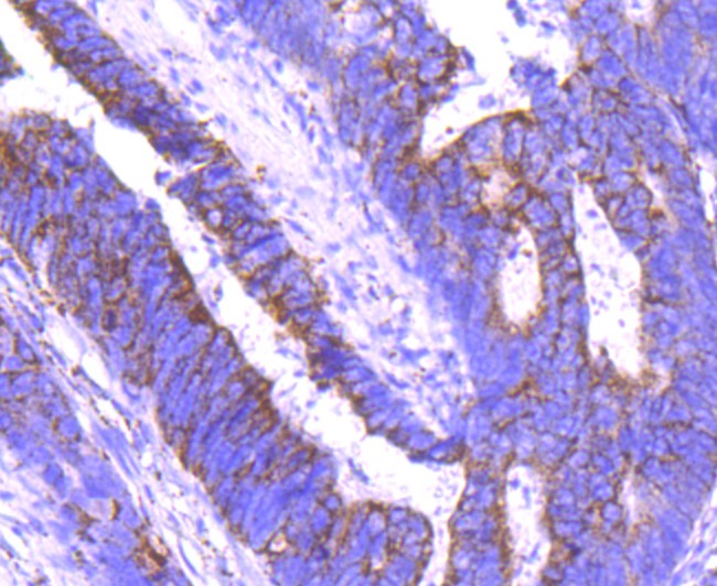 Immunohistochemical analysis of paraffin-embedded human colon carcinoma tissue using anti-Angiopoietin 2 antibody. The section was pre-treated using heat mediated antigen retrieval with Tris-EDTA buffer (pH 8.0-8.4) for 20 minutes.The tissues were blocked in 5% BSA for 30 minutes at room temperature, washed with ddH2O and PBS, and then probed with the primary antibody (ET1705-6, 1/50) for 30 minutes at room temperature. The detection was performed using an HRP conjugated compact polymer system. DAB was used as the chromogen. Tissues were counterstained with hematoxylin and mounted with DPX.