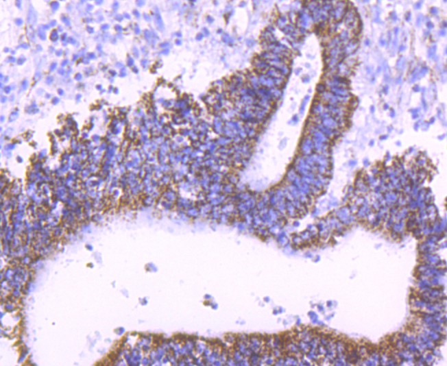 Immunohistochemical analysis of paraffin-embedded human colon carcinoma tissue using anti-mtTFA antibody. The section was pre-treated using heat mediated antigen retrieval with Tris-EDTA buffer (pH 8.0-8.4) for 20 minutes.The tissues were blocked in 5% BSA for 30 minutes at room temperature, washed with ddH2O and PBS, and then probed with the primary antibody (ET1705-64, 1/50) for 30 minutes at room temperature. The detection was performed using an HRP conjugated compact polymer system. DAB was used as the chromogen. Tissues were counterstained with hematoxylin and mounted with DPX.