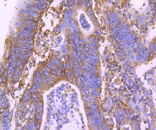 Immunohistochemical analysis of paraffin-embedded human colon carcinoma tissue using anti-MVP antibody. The section was pre-treated using heat mediated antigen retrieval with Tris-EDTA buffer (pH 8.0-8.4) for 20 minutes.The tissues were blocked in 5% BSA for 30 minutes at room temperature, washed with ddH2O and PBS, and then probed with the primary antibody (ET1705-69, 1/50) for 30 minutes at room temperature. The detection was performed using an HRP conjugated compact polymer system. DAB was used as the chromogen. Tissues were counterstained with hematoxylin and mounted with DPX.