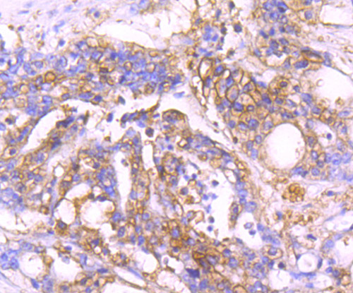Immunohistochemical analysis of paraffin-embedded human stomach carcinoma tissue using anti-MVP antibody. The section was pre-treated using heat mediated antigen retrieval with Tris-EDTA buffer (pH 8.0-8.4) for 20 minutes.The tissues were blocked in 5% BSA for 30 minutes at room temperature, washed with ddH2O and PBS, and then probed with the primary antibody (ET1705-69, 1/50) for 30 minutes at room temperature. The detection was performed using an HRP conjugated compact polymer system. DAB was used as the chromogen. Tissues were counterstained with hematoxylin and mounted with DPX.