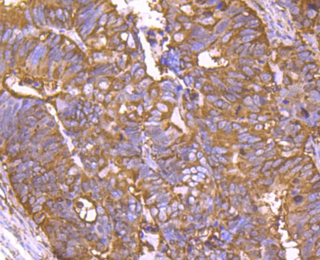 Immunohistochemical analysis of paraffin-embedded human colon carcinoma tissue with Rabbit anti-Cyclophilin F antibody (ET1705-7) at 1/50 dilution.<br />
<br />
The section was pre-treated using heat mediated antigen retrieval with Tris-EDTA buffer (pH 9.0) for 20 minutes. The tissues were blocked in 1% BSA for 20 minutes at room temperature, washed with ddH2O and PBS, and then probed with the primary antibody (ET1705-7) at 1/50 dilution for 1 hour at room temperature. The detection was performed using an HRP conjugated compact polymer system. DAB was used as the chromogen. Tissues were counterstained with hematoxylin and mounted with DPX.