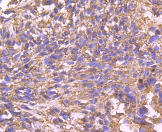 Immunohistochemical analysis of paraffin-embedded human breast carcinoma tissue with Rabbit anti-Cyclophilin F antibody (ET1705-7) at 1/50 dilution.<br />
<br />
The section was pre-treated using heat mediated antigen retrieval with Tris-EDTA buffer (pH 9.0) for 20 minutes. The tissues were blocked in 1% BSA for 20 minutes at room temperature, washed with ddH2O and PBS, and then probed with the primary antibody (ET1705-7) at 1/50 dilution for 1 hour at room temperature. The detection was performed using an HRP conjugated compact polymer system. DAB was used as the chromogen. Tissues were counterstained with hematoxylin and mounted with DPX.