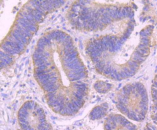 Immunohistochemical analysis of paraffin-embedded human prostate tissue using anti-ALIX antibody. The section was pre-treated using heat mediated antigen retrieval with Tris-EDTA buffer (pH 8.0-8.4) for 20 minutes.The tissues were blocked in 5% BSA for 30 minutes at room temperature, washed with ddH2O and PBS, and then probed with the primary antibody (ET1705-74, 1/50) for 30 minutes at room temperature. The detection was performed using an HRP conjugated compact polymer system. DAB was used as the chromogen. Tissues were counterstained with hematoxylin and mounted with DPX.