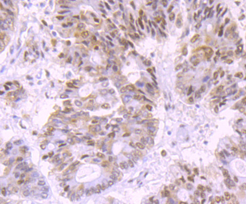 Immunohistochemical analysis of paraffin-embedded human colon carcinoma tissue using anti-DNA Ligase IV antibody. The section was pre-treated using heat mediated antigen retrieval with Tris-EDTA buffer (pH 9.0) for 20 minutes.The tissues were blocked in 1% BSA for 30 minutes at room temperature, washed with ddH2O and PBS, and then probed with the primary antibody (ET1705-77, 1/50) for 30 minutes at room temperature. The detection was performed using an HRP conjugated compact polymer system. DAB was used as the chromogen. Tissues were counterstained with hematoxylin and mounted with DPX.
