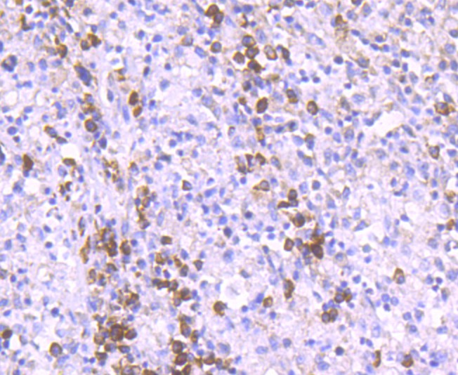 Immunohistochemical analysis of paraffin-embedded human stomach carcinoma tissue using anti-Epac1 antibody. The section was pre-treated using heat mediated antigen retrieval with Tris-EDTA buffer (pH 9.0) for 20 minutes.The tissues were blocked in 1% BSA for 30 minutes at room temperature, washed with ddH2O and PBS, and then probed with the primary antibody (ET1705-79, 1/50) for 30 minutes at room temperature. The detection was performed using an HRP conjugated compact polymer system. DAB was used as the chromogen. Tissues were counterstained with hematoxylin and mounted with DPX.