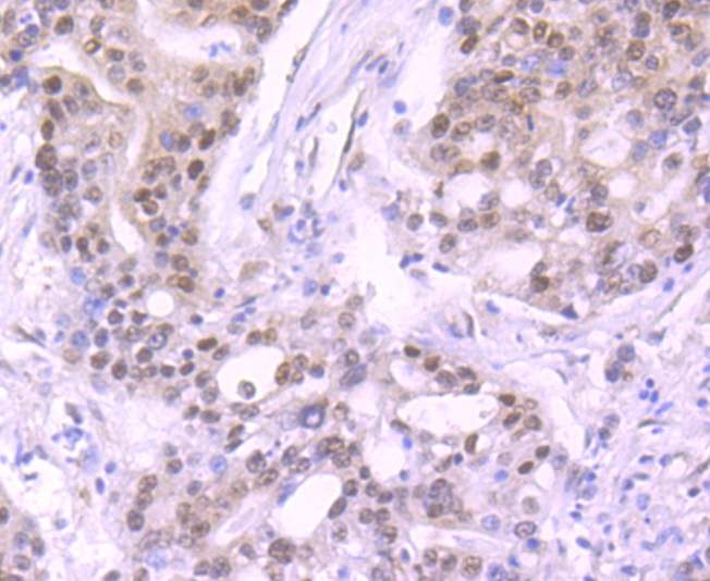 Immunohistochemical analysis of paraffin-embedded human stomach carcinoma tissue using anti-Cullin 1 antibody. The section was pre-treated using heat mediated antigen retrieval with Tris-EDTA buffer (pH 9.0) for 20 minutes.The tissues were blocked in 1% BSA for 30 minutes at room temperature, washed with ddH2O and PBS, and then probed with the primary antibody (ET1705-82, 1/50) for 30 minutes at room temperature. The detection was performed using an HRP conjugated compact polymer system. DAB was used as the chromogen. Tissues were counterstained with hematoxylin and mounted with DPX.