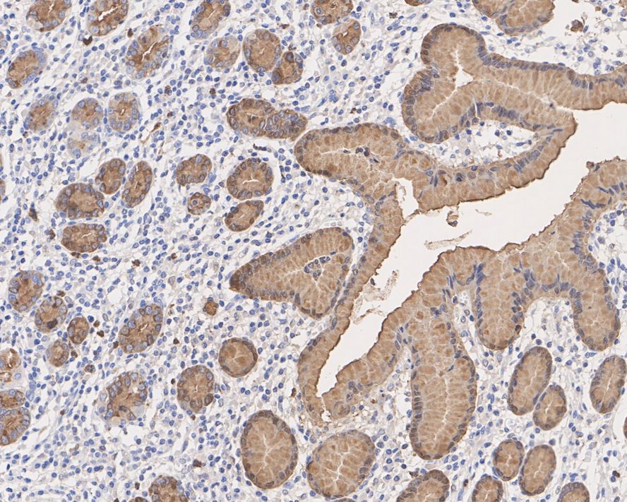 Immunohistochemical analysis of paraffin-embedded human stomach carcinoma tissue using anti-Estrogen Inducible Protein pS2 antibody. The section was pre-treated using heat mediated antigen retrieval with Tris-EDTA buffer (pH 9.0) for 20 minutes.The tissues were blocked in 1% BSA for 30 minutes at room temperature, washed with ddH2O and PBS, and then probed with the primary antibody (ET1705-85, 1/50) for 30 minutes at room temperature. The detection was performed using an HRP conjugated compact polymer system. DAB was used as the chromogen. Tissues were counterstained with hematoxylin and mounted with DPX.
