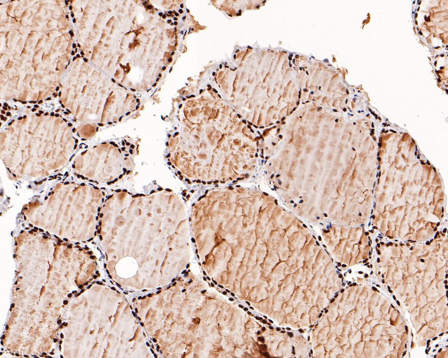 Immunohistochemical analysis of paraffin-embedded human thyroid tissue with Rabbit anti-NRF1 antibody (ET1705-86) at 1/1,000 dilution.<br />
<br />
The section was pre-treated using heat mediated antigen retrieval with sodium citrate buffer (pH 6.0) for 2 minutes. The tissues were blocked in 1% BSA for 20 minutes at room temperature, washed with ddH2O and PBS, and then probed with the primary antibody (ET1705-86) at 1/1,000 dilution for 1 hour at room temperature. The detection was performed using an HRP conjugated compact polymer system. DAB was used as the chromogen. Tissues were counterstained with hematoxylin and mounted with DPX.