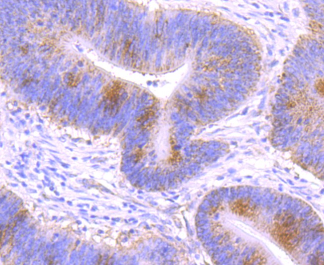 Immunohistochemical analysis of paraffin-embedded human colon carcinoma tissue using anti-GCLM antibody. The section was pre-treated using heat mediated antigen retrieval with Tris-EDTA buffer (pH 8.0-8.4) for 20 minutes.The tissues were blocked in 5% BSA for 30 minutes at room temperature, washed with ddH2O and PBS, and then probed with the primary antibody (ET1705-87, 1/50) for 30 minutes at room temperature. The detection was performed using an HRP conjugated compact polymer system. DAB was used as the chromogen. Tissues were counterstained with hematoxylin and mounted with DPX.