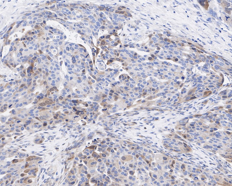 Immunohistochemical analysis of paraffin-embedded rat epididymis tissue with Rabbit anti-Rad51 antibody (ET1705-96) at 1/200 dilution.<br />
<br />
The section was pre-treated using heat mediated antigen retrieval with sodium citrate buffer (pH 6.0) for 2 minutes. The tissues were blocked in 1% BSA for 20 minutes at room temperature, washed with ddH2O and PBS, and then probed with the primary antibody (ET1705-96) at 1/200 dilution for 1 hour at room temperature. The detection was performed using an HRP conjugated compact polymer system. DAB was used as the chromogen. Tissues were counterstained with hematoxylin and mounted with DPX.