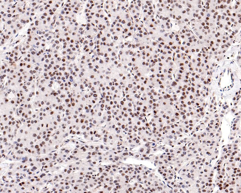 Immunohistochemical analysis of paraffin-embedded human liver carcinoma tissue using anti-HP1 gamma antibody. The section was pre-treated using heat mediated antigen retrieval with sodium citrate buffer (pH 6.0) for 20 minutes. The tissues were blocked in 5% BSA for 30 minutes at room temperature, washed with ddH2O and PBS, and then probed with the primary antibody (ET1706-02, 1/200)  for 30 minutes at room temperature. The detection was performed using an HRP conjugated compact polymer system. DAB was used as the chromogen. Tissues were counterstained with hematoxylin and mounted with DPX.