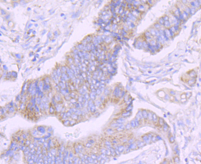 Immunohistochemical analysis of paraffin-embedded  human colon carcinoma tissue with Rabbit anti-NDUFS3 antibody (ET1706-07) at 1/50 dilution.<br />
<br />
The section was pre-treated using heat mediated antigen retrieval with Tris-EDTA buffer (pH 9.0) for 20 minutes. The tissues were blocked in 1% BSA for 20 minutes at room temperature, washed with ddH2O and PBS, and then probed with the primary antibody (ET1706-07) at 1/50 dilution for 0.5 hour at room temperature. The detection was performed using an HRP conjugated compact polymer system. DAB was used as the chromogen. Tissues were counterstained with hematoxylin and mounted with DPX.