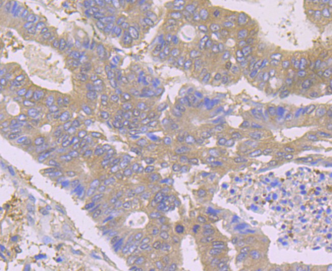Immunohistochemical analysis of paraffin-embedded  human colon carcinoma tissue with Rabbit anti-HPRT antibody (ET1706-08) at 1/50 dilution.<br />
<br />
The section was pre-treated using heat mediated antigen retrieval with Tris-EDTA buffer (pH 8.0-8.4) for 20 minutes. The tissues were blocked in 1% BSA for 20 minutes at room temperature, washed with ddH2O and PBS, and then probed with the primary antibody (ET1706-08) at 1/50 dilution for 0.5 hour at room temperature. The detection was performed using an HRP conjugated compact polymer system. DAB was used as the chromogen. Tissues were counterstained with hematoxylin and mounted with DPX.