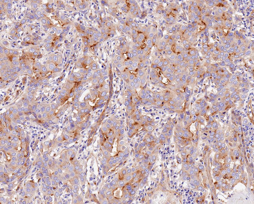 Immunohistochemical analysis of paraffin-embedded human liver carcinoma tissue using anti-Fragilis antibody. The section was pre-treated using heat mediated antigen retrieval with Tris-EDTA buffer (pH 9.0) for 20 minutes.The tissues were blocked in 5% BSA for 30 minutes at room temperature, washed with ddH2O and PBS, and then probed with the primary antibody (ET1706-09, 1/50) for 30 minutes at room temperature. The detection was performed using an HRP conjugated compact polymer system. DAB was used as the chromogen. Tissues were counterstained with hematoxylin and mounted with DPX.