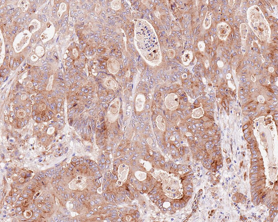 Immunohistochemical analysis of paraffin-embedded human colon carcinoma tissue using anti-Fragilis antibody. The section was pre-treated using heat mediated antigen retrieval with Tris-EDTA buffer (pH 9.0) for 20 minutes.The tissues were blocked in 5% BSA for 30 minutes at room temperature, washed with ddH2O and PBS, and then probed with the primary antibody (ET1706-09, 1/50) for 30 minutes at room temperature. The detection was performed using an HRP conjugated compact polymer system. DAB was used as the chromogen. Tissues were counterstained with hematoxylin and mounted with DPX.