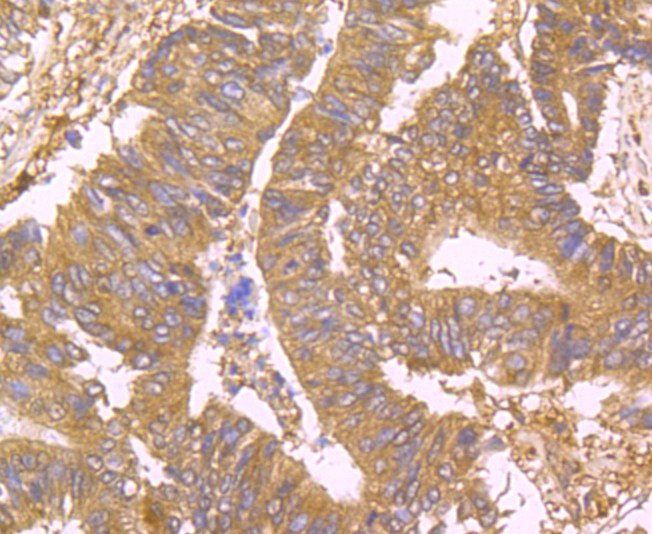 Immunohistochemical analysis of paraffin-embedded  human liver tissue tissue with Rabbit anti-USP10 antibody (ET1706-12) at 1/50 dilution.<br />
<br />
The section was pre-treated using heat mediated antigen retrieval with Tris-EDTA buffer (pH 8.0-8.4) for 20 minutes. The tissues were blocked in 1% BSA for 20 minutes at room temperature, washed with ddH2O and PBS, and then probed with the primary antibody (ET1706-12) at 1/50 dilution for 0.5 hour at room temperature. The detection was performed using an HRP conjugated compact polymer system. DAB was used as the chromogen. Tissues were counterstained with hematoxylin and mounted with DPX.