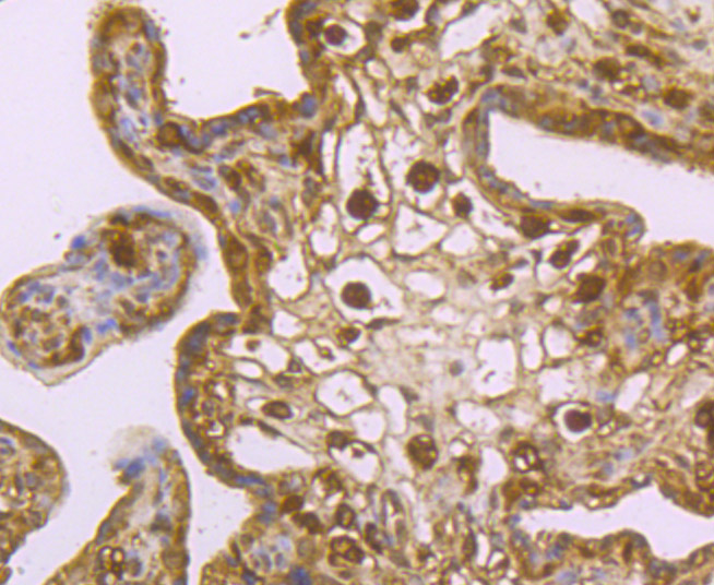 Immunohistochemical analysis of paraffin-embedded human colon cancer tissue using anti-USP10 antibody. Counter stained with hematoxylin.