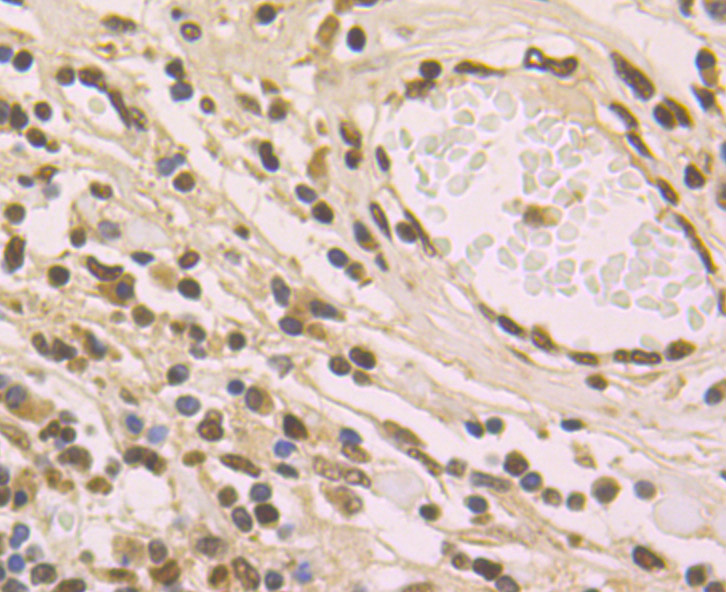 Immunohistochemical analysis of paraffin-embedded  human lung carcinoma tissue with Rabbit anti-macroH2A.1 antibody (ET1706-15) at 1/50 dilution.<br />
<br />
The section was pre-treated using heat mediated antigen retrieval with sodium citrate buffer (pH 6.0) for 2 minutes. The tissues were blocked in 1% BSA for 20 minutes at room temperature, washed with ddH2O and PBS, and then probed with the primary antibody (ET1706-15) at 1/50 dilution for 1 hour at room temperature. The detection was performed using an HRP conjugated compact polymer system. DAB was used as the chromogen. Tissues were counterstained with hematoxylin and mounted with DPX.