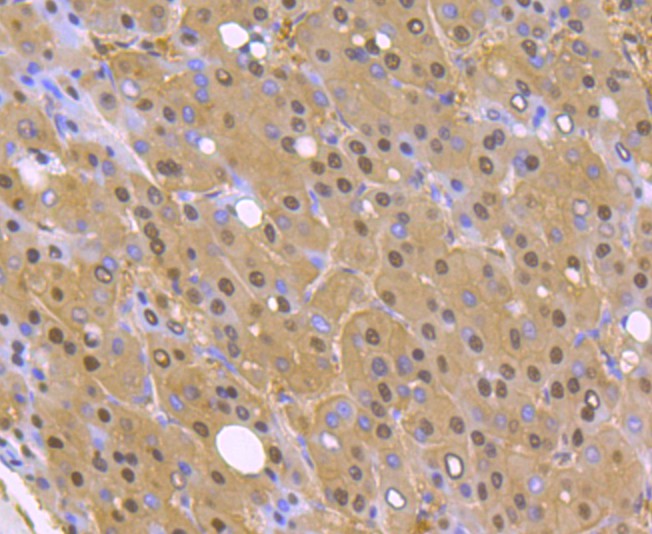 Immunohistochemical analysis of paraffin-embedded human liver carcinoma tissue with Rabbit anti-PSMA1 antibody (ET1706-19) at 1/50 dilution.<br />
<br />
The section was pre-treated using heat mediated antigen retrieval with Tris-EDTA buffer (pH 8.0-8.4) for 20 minutes. The tissues were blocked in 1% BSA for 20 minutes at room temperature, washed with ddH2O and PBS, and then probed with the primary antibody (ET1706-19) at 1/50 dilution for 0.5 hour at room temperature. The detection was performed using an HRP conjugated compact polymer system. DAB was used as the chromogen. Tissues were counterstained with hematoxylin and mounted with DPX.