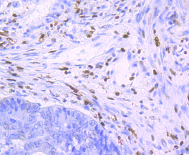 Immunohistochemical analysis of paraffin-embedded human colon carcinoma tissue using anti-SAMHD1 antibody. The section was pre-treated using heat mediated antigen retrieval with sodium citrate buffer (pH 6.0) for 20 minutes. The tissues were blocked in 1% BSA for 30 minutes at room temperature, washed with ddH2O and PBS, and then probed with the primary antibody (ET1706-24, 1/50)  for 30 minutes at room temperature. The detection was performed using an HRP conjugated compact polymer system. DAB was used as the chromogen. Tissues were counterstained with hematoxylin and mounted with DPX.