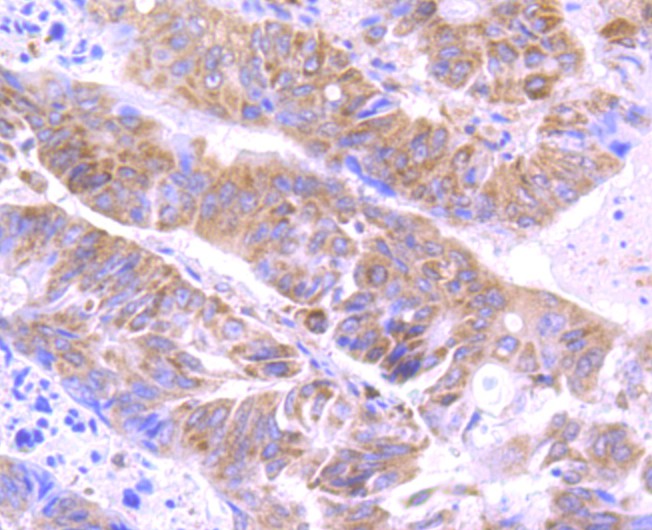 Immunohistochemical analysis of paraffin-embedded  human colon carcinoma tissue with Rabbit anti-Apg3 antibody (ET1706-29) at 1/100 dilution.<br />
<br />
The section was pre-treated using heat mediated antigen retrieval with sodium citrate buffer (pH 6.0) for 2 minutes. The tissues were blocked in 1% BSA for 20 minutes at room temperature, washed with ddH2O and PBS, and then probed with the primary antibody (ET1706-29) at 1/100 dilution for 1 hour at room temperature. The detection was performed using an HRP conjugated compact polymer system. DAB was used as the chromogen. Tissues were counterstained with hematoxylin and mounted with DPX.