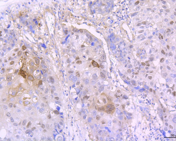 Immunohistochemical analysis of paraffin-embedded human lung carcinoma tissue with Rabbit anti-Involucrin antibody (ET1706-32) at 1/50 dilution.<br />
<br />
The section was pre-treated using heat mediated antigen retrieval with Tris-EDTA buffer (pH 8.0-8.4) for 20 minutes. The tissues were blocked in 1% BSA for 20 minutes at room temperature, washed with ddH2O and PBS, and then probed with the primary antibody (ET1706-32) at 1/50 dilution for 0.5 hour at room temperature. The detection was performed using an HRP conjugated compact polymer system. DAB was used as the chromogen. Tissues were counterstained with hematoxylin and mounted with DPX.